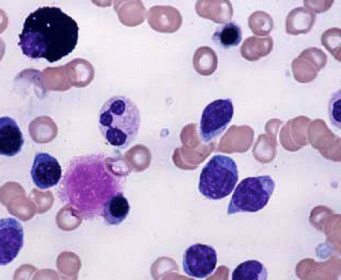 Почему много лимфоцитов в крови