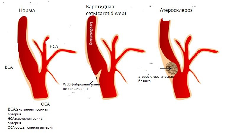 Стеноз сонной артерии. Атеросклероз сосудов брахиоцефальных артерий. Луковица общей сонной артерии. Клинические проявления атеросклероза брахиоцефальных артерий.